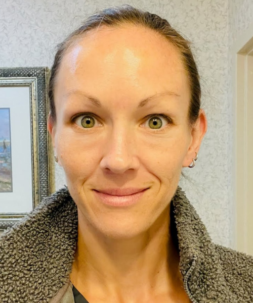 After Image: Botox - front