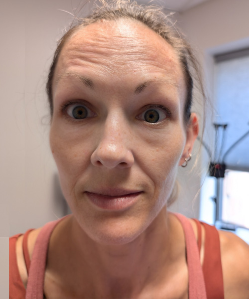 Before Image: Botox - front