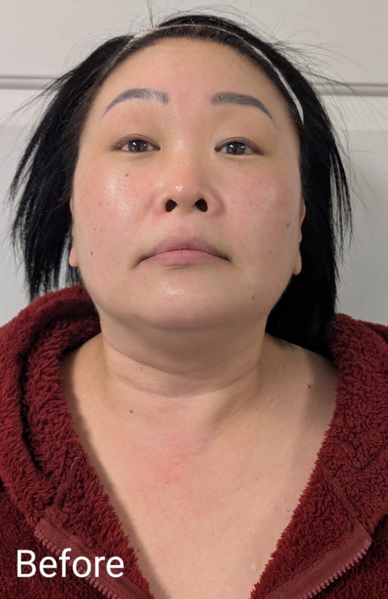Before Image: Chemical Peel - front