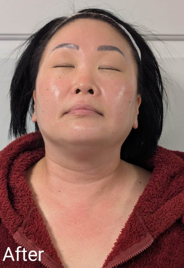 After Image: Chemical Peel - front